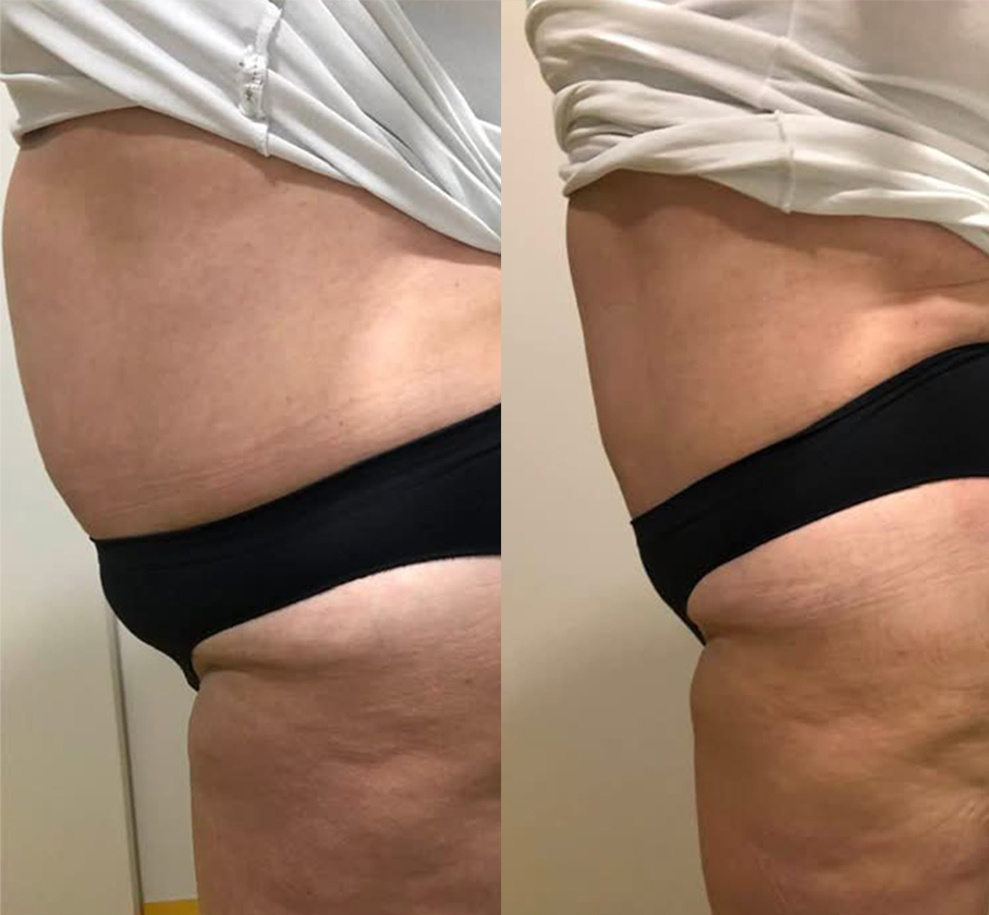 Resultado antes e depois — ES Estética Saúde