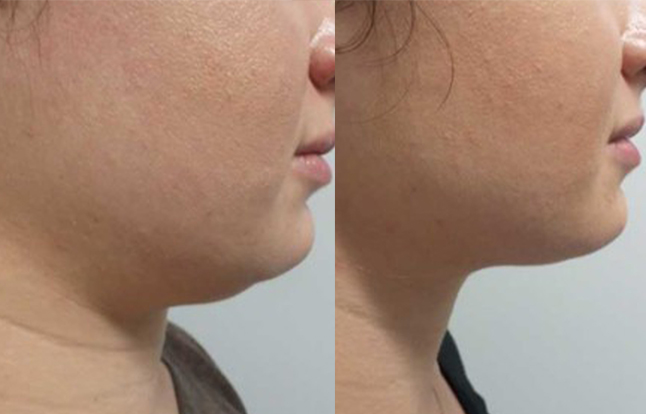 Resultado antes e depois — ES Estética Saúde