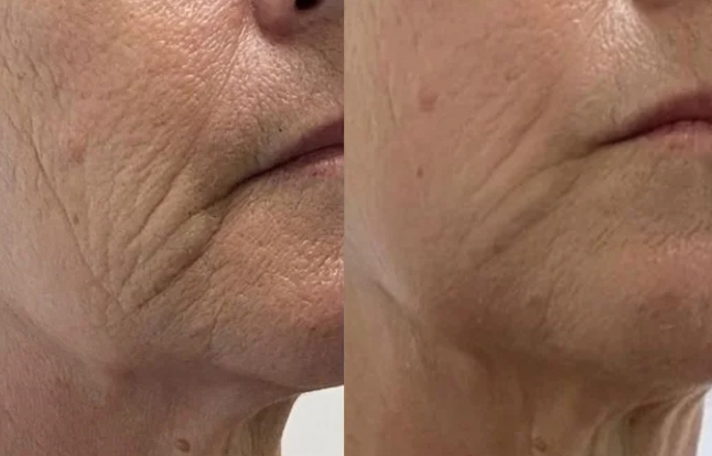 Resultado antes e depois — ES Estética Saúde