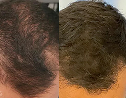 Resultado antes e depois — ES Estética Saúde