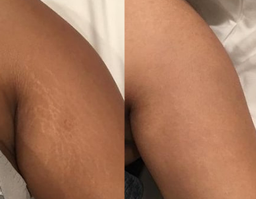 Resultado antes e depois — ES Estética Saúde