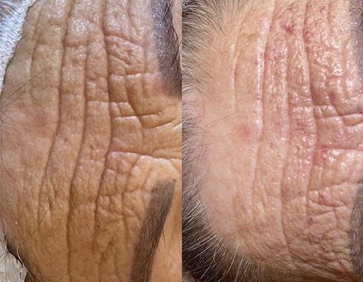 Resultado antes e depois — ES Estética Saúde